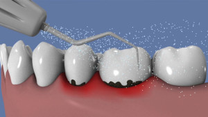 Laser et traitement de la parodontite
